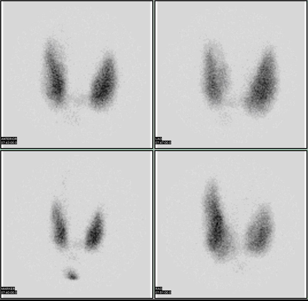 Radioactive Iodine (I-123) thyroid scan images. Photo by Myo Han, sourced from Wikipedia. 